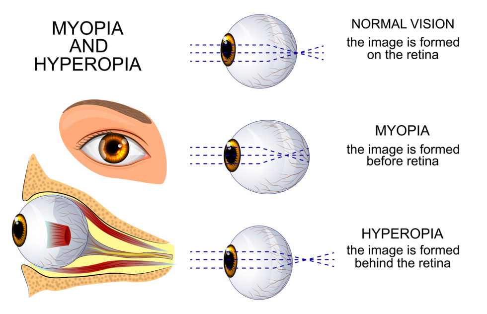 a push-up tiltott myopia)