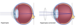 a hyperopia élesen kialakult látáskezelés rókagombával